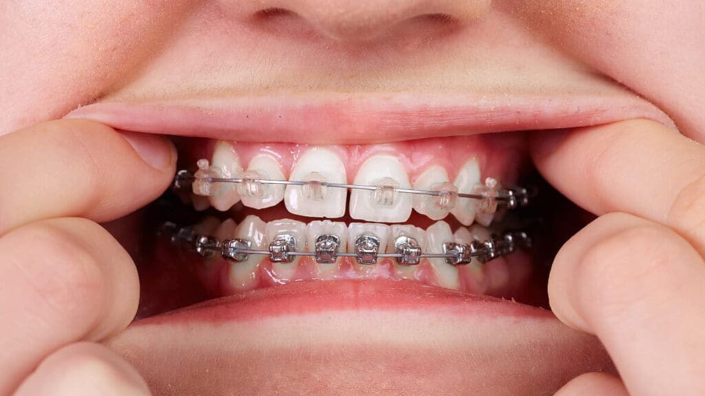 Ưu điểm nổi bật nhất của niềng răng mắc cài sứ là tính thẩm mỹ cao