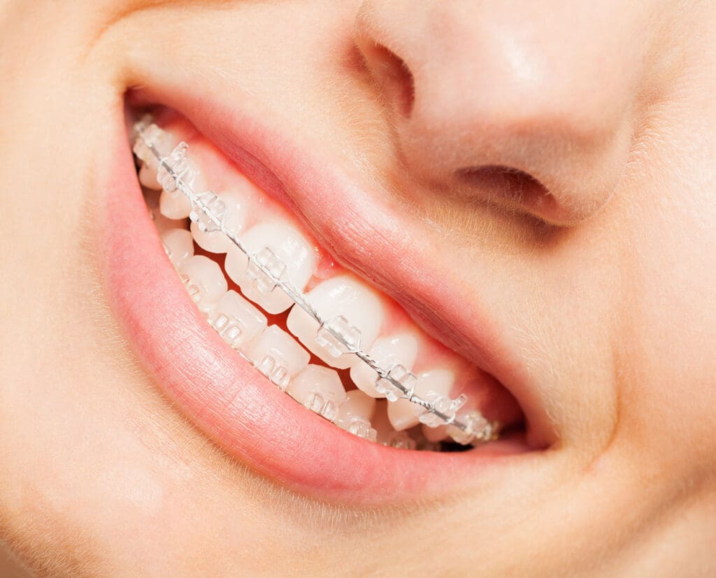 Niềng răng mắc cài sứ với dây cung mạ màu trắng
