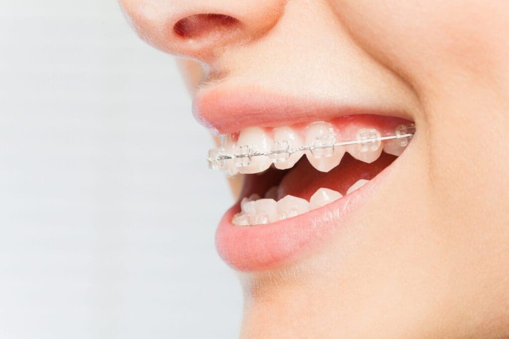 niềng răng mắc cài sứ
