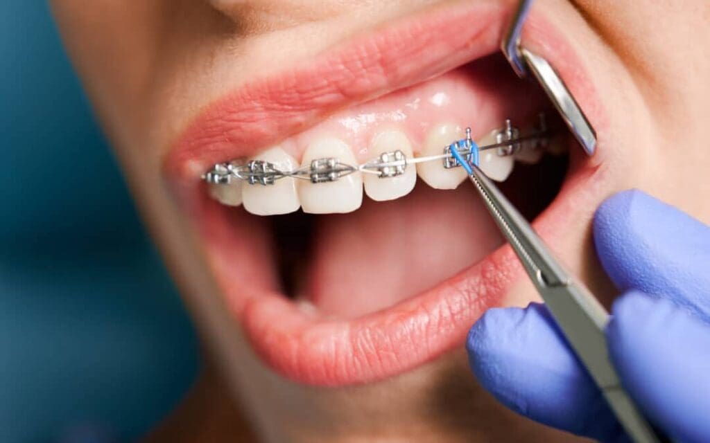 Điều chỉnh lực trên mắc cài kim loại khi tái khám định kỳ