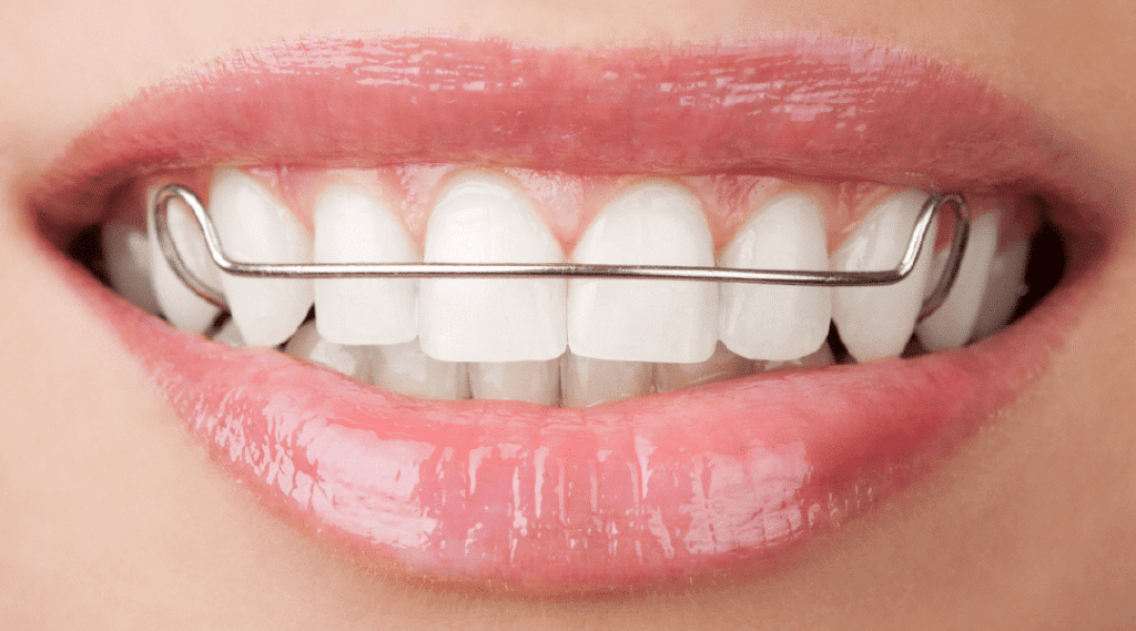 Gắn hàm duy trì sau khi niềng răng