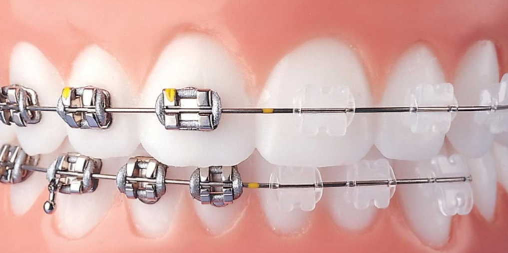 mắc cài sứ có tính thẩm mỹ cao hơn mắc cài kim loại