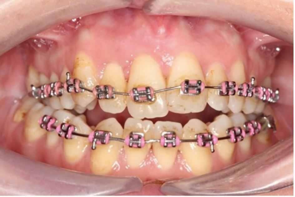 Niềng răng mắc cài kim loại trong trường hợp răng lệch lạc nặng