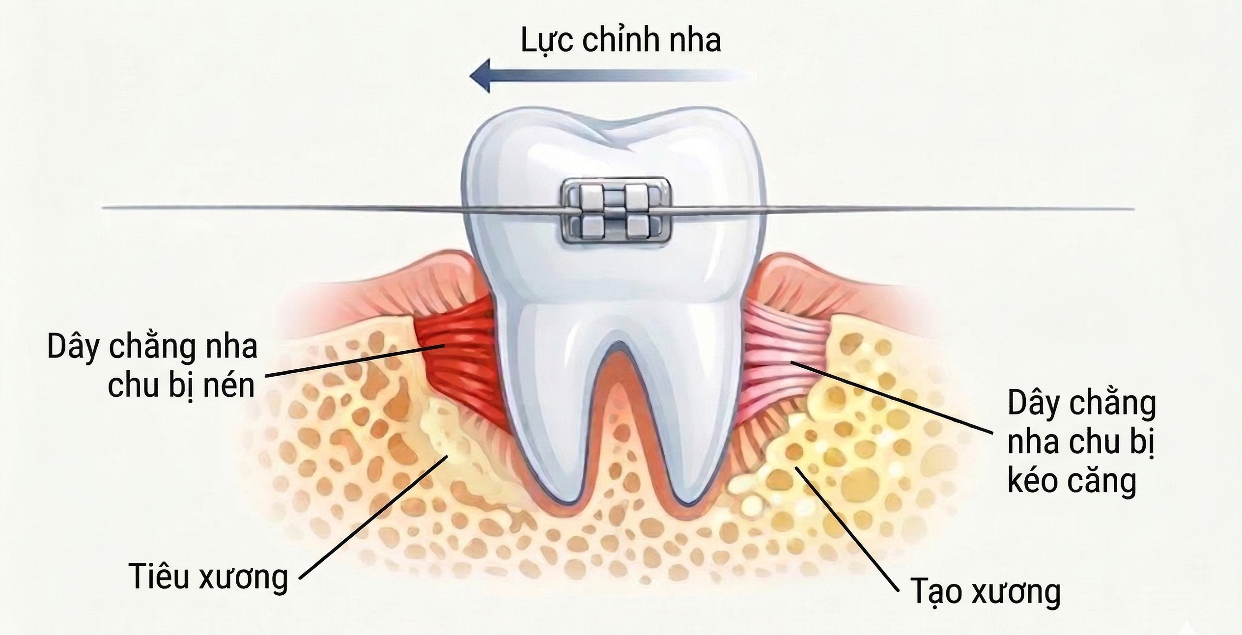 Sơ đồ đơn giản cho thấy lực chỉnh nha tạo thay đổi ở mô quanh răng khiến vùng này nhạy cảm hơn trong vài ngày đầu
